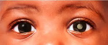 Retinoblastoma: de olho nos olhinhos para salvar vidas